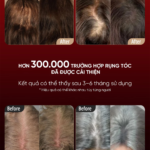 Lược Điện Massage Da Đầu BREO Scalp 3L | Ánh Sáng Laser 3R – Phát Triển Nang Tóc | Bảo hành 12 Tháng