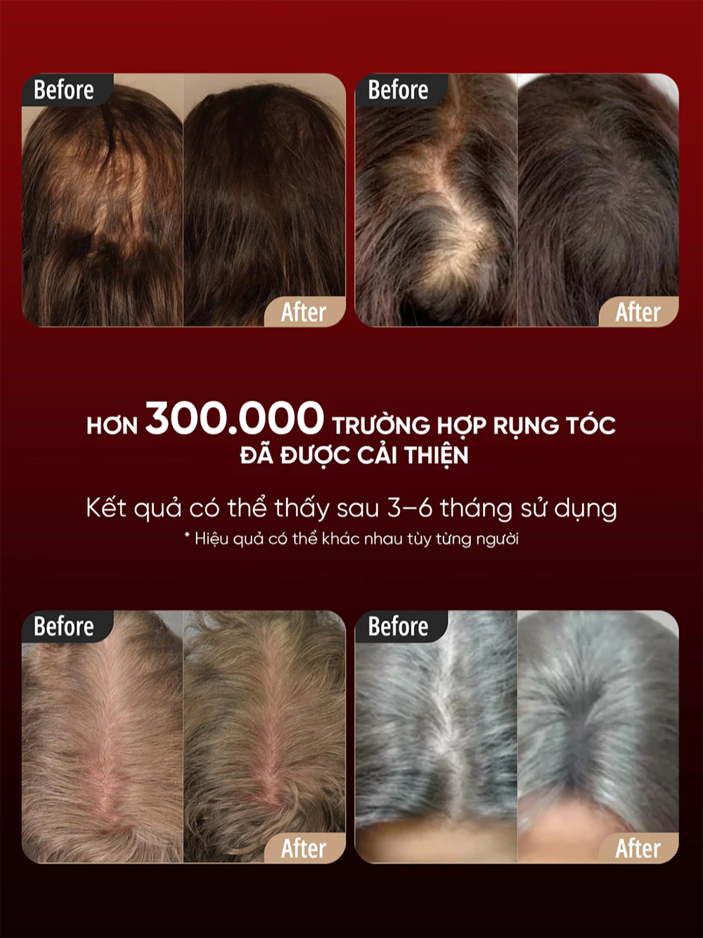 Lược Điện Massage Da Đầu BREO Scalp 3L | Ánh Sáng Laser 3R - Phát Triển Nang Tóc | Bảo hành 12 Tháng 57 Breo Scalp 3L 2